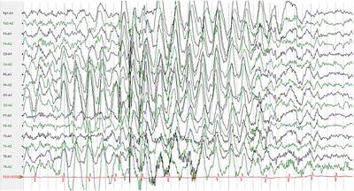 Identification of Two de novo Variants of CACNA1A in Pediatric Chinese Patients With Paroxysmal Tonic Upgaze